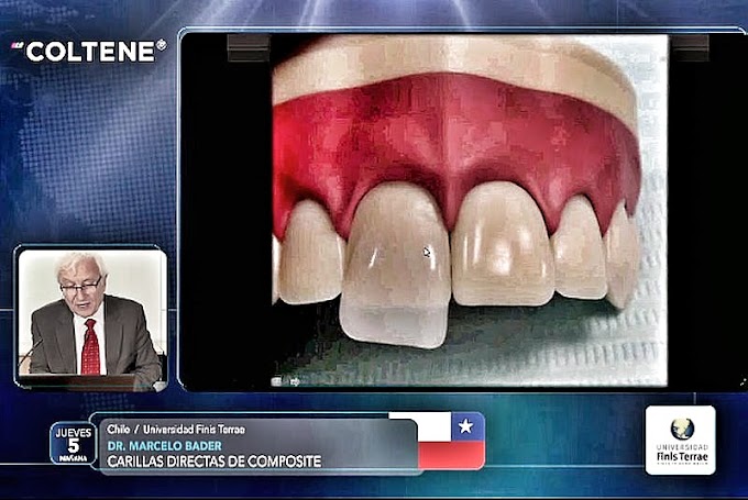 VIDEOCONFERENCIA: Carillas Dentales directas de Composite - Dr. Marcelo Bader