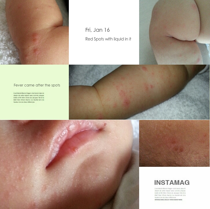 Affected with HFMD? What to do next? Sebrinah Yeo