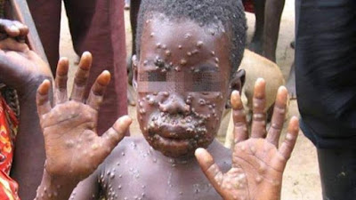 Bocah afrika terserang monkeypox