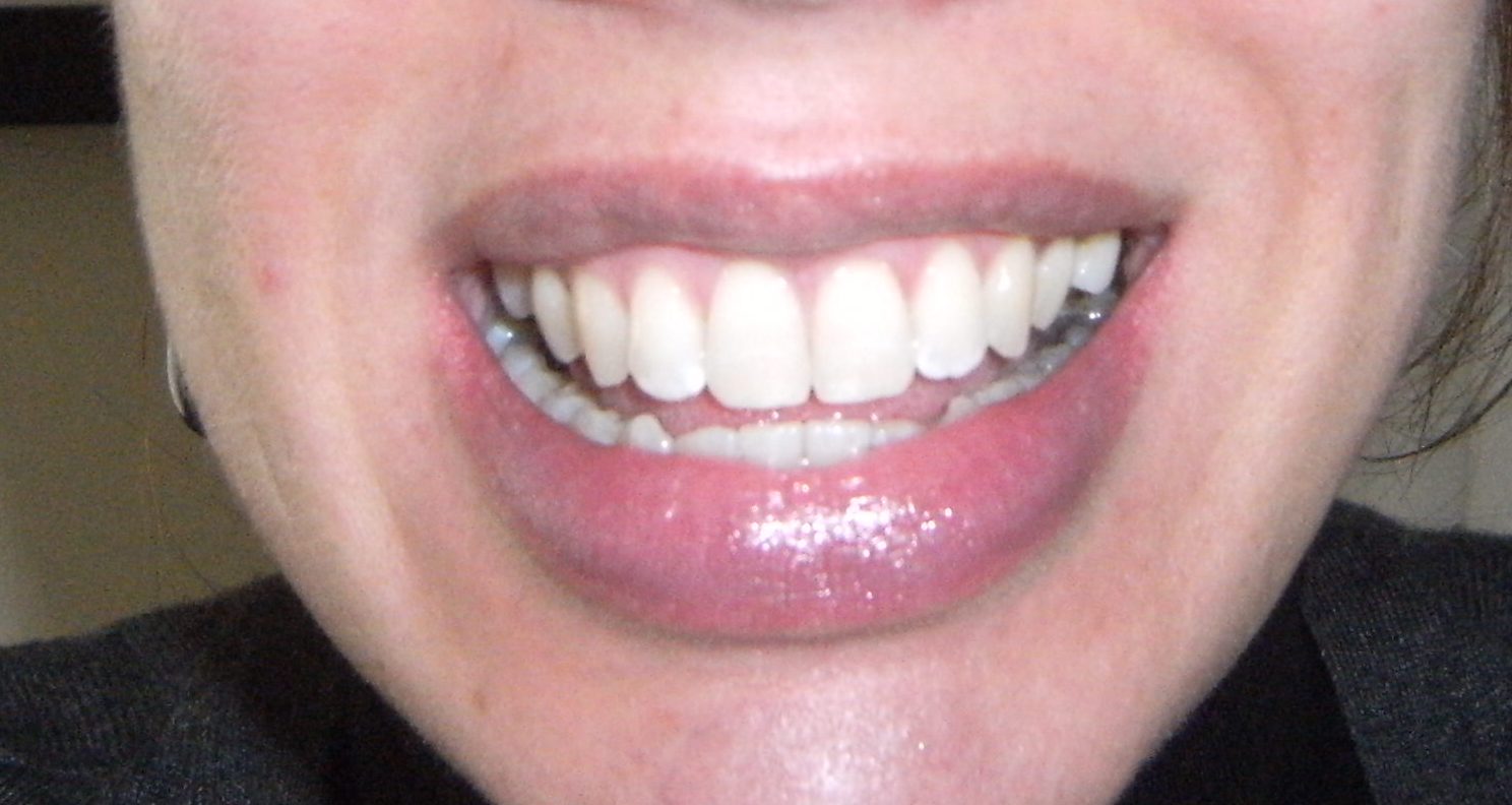 to my invisalign blog...... Teeth straightening officially