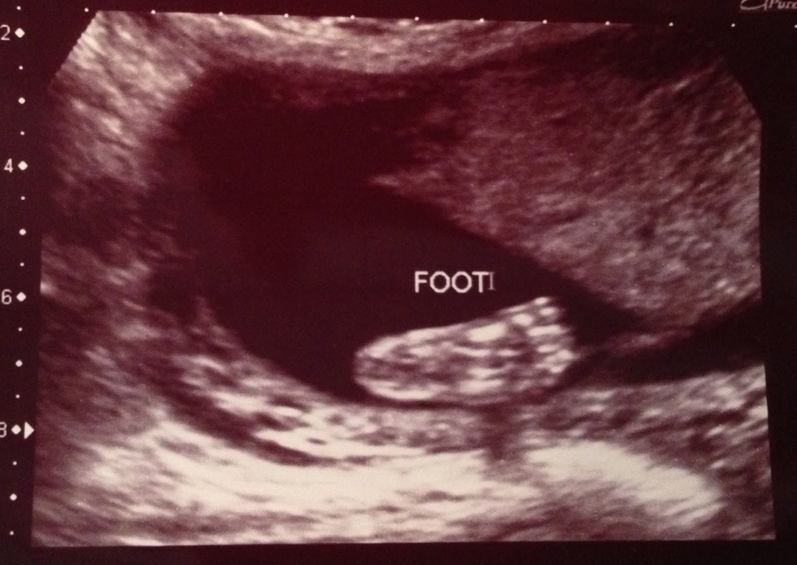 How to Make a Smile Baby Girl 20 week ultrasound