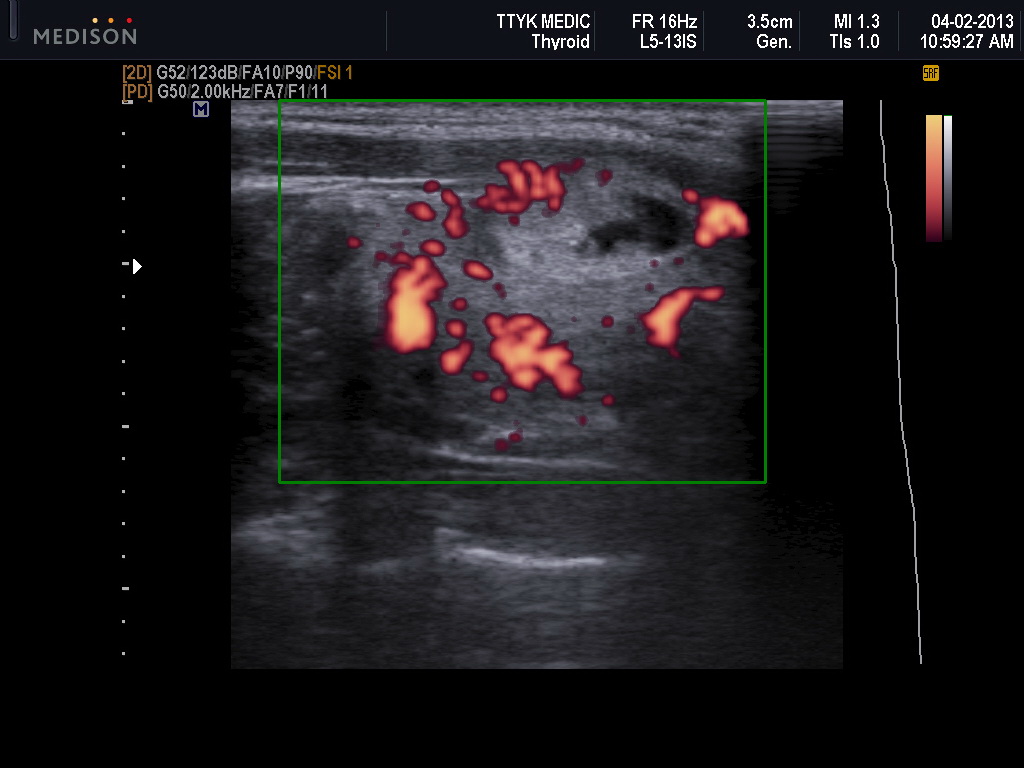 Vietnamese Medic Ultrasound Case Thyroid Nodule In A Girl Dr Phan