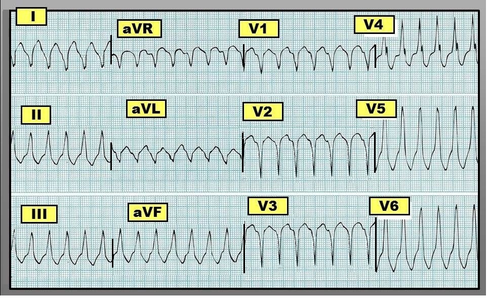 ECG Interpretation: ECG Interpretation Review #35 (SCT - VT ...