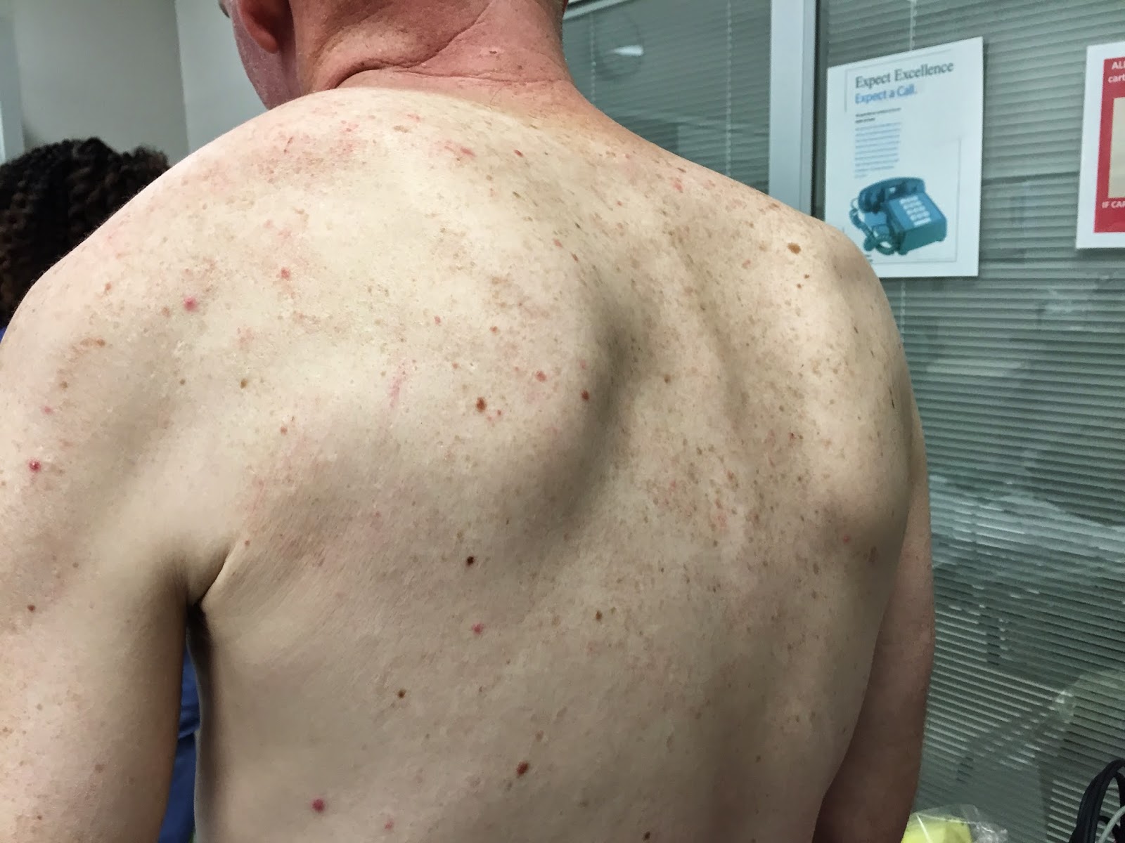 Shoulder and Elbow Surgery Locked scapula syndrome (or scapular