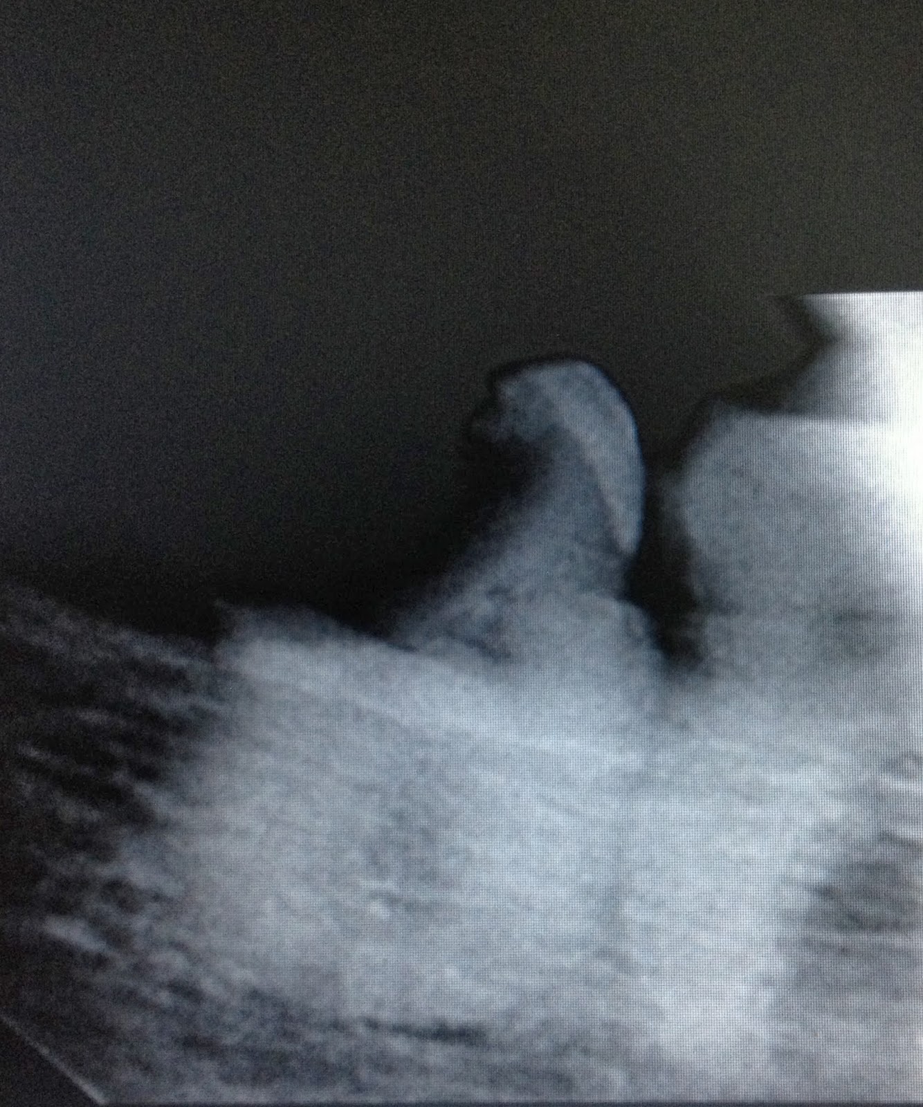 LaDivya SuperSpeciality Dental Clinic: Distoangular Impacted Wisdom Tooth