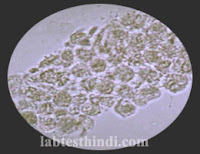 Urine Microscopic -epith. casts