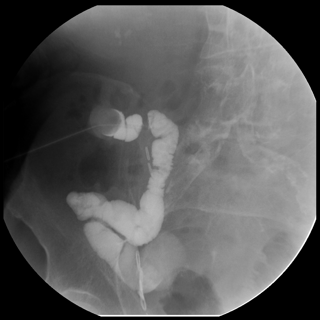 Topics in Radiography: Loopogram