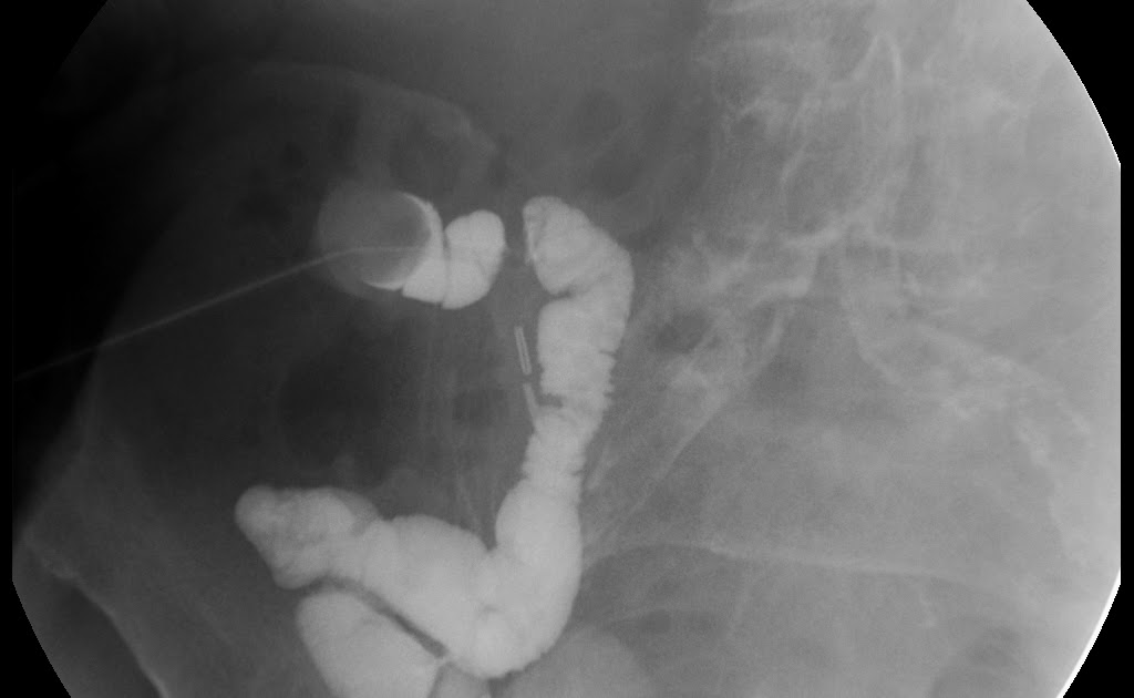Topics in Radiography: Loopogram