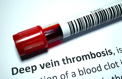 Penyakit Deep Vein Thrombosis Pada Tubuh Manusia Pengertian Deep Vein Thrombosis Deep Vein Thrombosis (DVT) adalah suatu penyakit yang terjadi ketika terdapat gumpalan darah di pembuluh darah. Pembuluh darah vena yang terkena biasanya terletak jauh di dalam otot kaki tetapi juga bisa dalam area lainnya. Gumpalan (trombus) menyebabkan aliran darah melambat. Daerah tersumbat menjadi bengkak, merah, dan menyakitkan. Jika gumpalan bergerak ke paru-paru, maka emboli paru (vena di paru-paru tersumbat) dapat terjadi, menimbulkan masalah pernapasan serius.  Tanda dan Gejala Deep Vein Thrombosis Hanya sekitar setengah dari orang yang mengalami DVT memiliki tanda-tanda dan gejala. Tanda dan gejala muncul pada kaki dipengaruhi oleh gumpalan yang terdapat di dalam vena. Gejala tersebut yaitu : Pembengkakan kaki atau sepanjang vena di kaki Nyeri di kaki, yang dirasakan hanya ketika berdiri atau berjalan Peningkatan suhu di daerah kaki yang bengkak atau terasa sakit Kemerahan atau berubahnya warna pada kulit kaki Beberapa orang tidak menyadari adanya gumpalan pada vena dalam sampai meraka memiliki tanda-tanda dan gejala pulmonary embolism. Tanda dan gejalanya meliputi : Sesak napas tanpa sebab Nyeri ketika melakukan pernapasan dalam Batuk berdarah Napas terlalu cepat dan detak jantung yang cepat juga mungkin tanda-tanda dari EP. Kemungkinan ada tanda-tanda dan gejala yang tidak disebutkan di atas. Bila memilik sebuah keluhan silahkan konsultasikan ke dokter.  Penyebab Deep Vein Thrombosis Gumpalan darah dapat terbentuk di vena dalam tubuh jika : Sebuah lapisan dalam pembuluh darah rusak Luka yang disebabkan oleh faktor fisik, kimia, atau faktor biologis dapat merusak pembuluh darah. Faktor-faktor tersebut termasuk operasi, luka serius, peradangan, dan reaksi imun. Aliran darah lambat Kurang beraktivitas dapat menyebabkan aliran darah lambat. Hal ini mungkin terjadi setelah operasi, jika sakit dan harus berada di tempat tidur untuk waktu yang lama, atau jika bepergian untuk waktu yang lama. Darah lebih kental atau lebih rentan untuk menggumpal dari biasanya Beberapa kondisi yang diwariskan (seperti faktor V Leiden) meningkatkan risiko penggumpalan darah. Terapi hormon atau pil KB juga dapat meningkatkan risiko penggumpalan darah.  Faktor Risiko Deep Vein Thrombosis Berikut ini adalah faktor risiko dari Deep Vein Thrombosis atau DVT : Mewarisi gangguan penggumpalan darah Beberapa orang mewarisi gangguan yang membuat gumpalan darah mereka lebih mudah. Kondisi menurun ini mungkin tidak menyebabkan masalah kecuali dikombinasikan dengan satu atau lebih faktor risiko lainnya. Tidur berkepanjangan, seperti tinggal di rumah sakit cukup lama, atau kelumpuhan Ketika kaki tidak bergerak untuk waktu yang lama, otot betis tidak berkontraksi untuk membantu mengalirkan darah, yang dapat meningkatkan risiko penggumpalan darah. Cedera atau pembedahan Cedera pembuluh darah atau operasi dapat meningkatkan risiko pengumpalan darah. Kehamilan Kehamilan meningkatkan tekanan dalam pembuluh darah di panggul dan kaki. Wanita dengan gangguan penggumpalan darah karena keturunan sangat berisiko. Risiko penggumpalan darah dari kehamilan dapat terus ada sampai enam minggu setelah memiliki bayi. Pil KB atau terapi hormon Pil KB (kontrasepsi oral) dan terapi penggantian hormoe dapat meningkatkan kemampuan darah untuk menggumpal. Kelebihan berat badan atau obesitas Kelebihan berat badan dapat meningkatkan tekanan dalam pembuluh darah di panggul dan kaki. Merokok Merokok mempengaruhi penggumpalan dan sirkulasi darah, yang dapat meningkatkan risiko DVT. Kanker Beberapa bentuk kanker meningkatkan jumlah zat dalam darah yang menyebabkan darah menggumpal. Beberapa bentuk pengobatan kanker juga meningkatkan risiko penggumpalan darah. Gagal jantung Orang yang mengalami gagal jantung memiliki risiko yang lebih besar terkena DVT dan pulmonary embolism. Karena orang-orang dengan gagal jantung yang sudah memiliki fungsi paru-paru dan hati yang terbatas, gejala kecil yang disebabkan oleh pulmonary embolism bahkan dapat lebih terlihat. Penyakit radang usus Penyakit usus, seperti penyakit crohn atau kolitis ulserativa, meningkatkan risiko DVT. Riwayat pribadi atau keluarga yang mengalami deep vein thrombosis atau pulmonary embolism. Jika seseorang atau dalam keluarga memiliki DVT atau PE sebelumnya, maka lebih rentan untuk mengaami DVT. Usia Memiliki usia di atas 60 tahun meningkatkan risiko DVT, meskipun dapat terjadi pada semua golongan usia. Duduk dalam jangka waktu yang lama, seperti ketika mengemudi atau di dalam pesawat terbang. Ketika kaki tidak bergerak selama berjam-jam, otot betis tidak berkontraksi, yang biasanya membantu mengalirkan darah. Gumpalan darah dapat terbentuk di betis kaki jika otot betis tidak bergerak untuk waktu yang lama.  Nah itu dia bahasan dari penyakit deep vein thrombosis pada tubuh manusia, melalui bahasan di atas bisa diketahui mengenai pengertian, tanda dan gejala, penyebab, dan faktor risiko dari penyakit ini. Mungkin hanya itu yang bisa disampaikan di dalam artikel ini, mohon maaf bila terjadi kesalahan di dalam penulisan, terimakasih telah membaca artikel ini."God Bless and Protect Us"