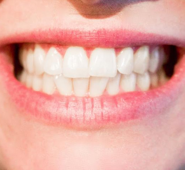Teeth Whitening Donvale