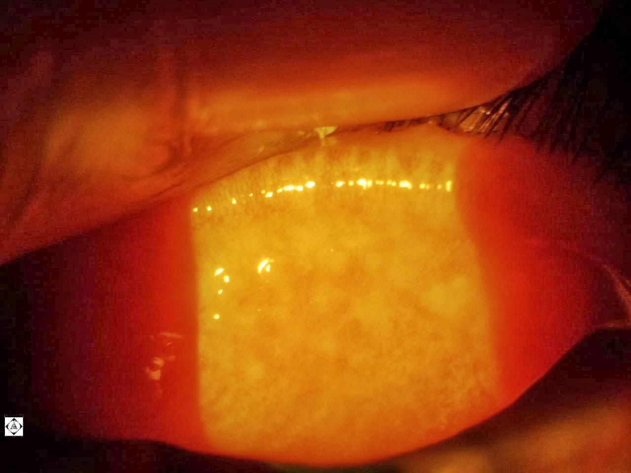 Sonoran Desert Eye Center GIANT PAPILLARY CONJUNCTIVITIS (GPC)