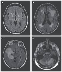 MRI for diagnosing encephalitis