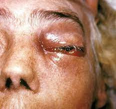 Image showing Mucormycosis
