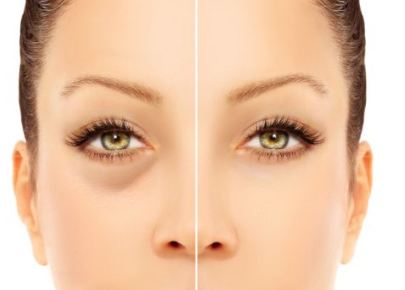 Tips to Reduce Under Eye Circles - Skin care For You Tips to Reduce Under Eye Circles - Skin care For You