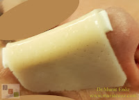 Nasal cast (external nasal splint)