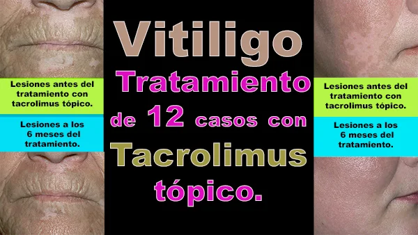 Vitiligo, Tratamiento de 12 casos con tacrolimus tópico