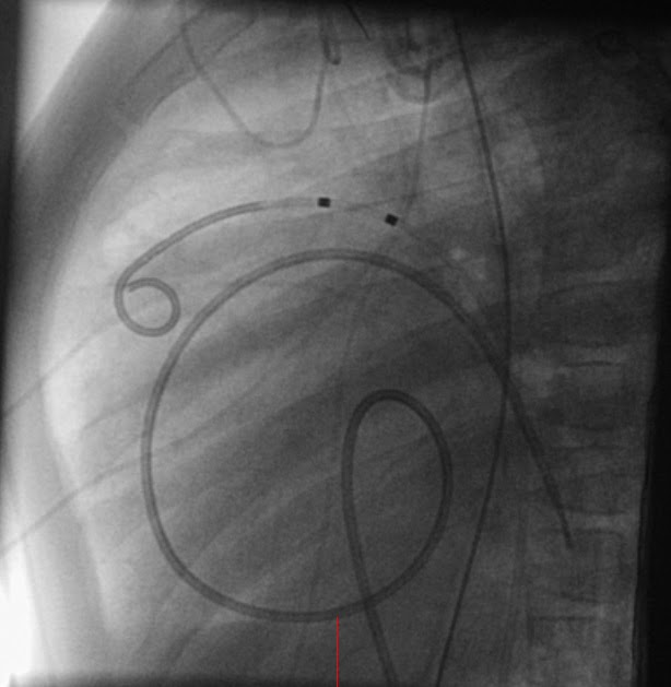 PediCardiology Quiz Quiz 20 Cardiac Catheterization