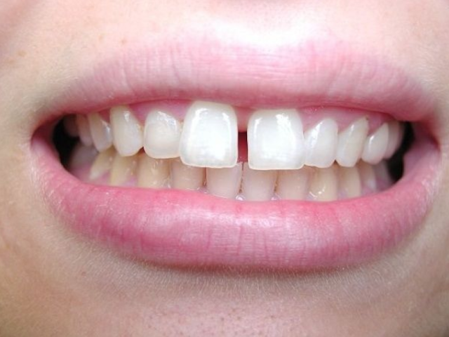 luu-y-khi-nieng-rang-invisalign-3.jpg