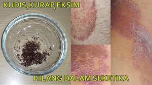 Jamur obat ampuh apotik kulit paling gatal di Macam obat