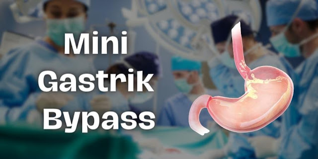 Mini Gastrik Bypass