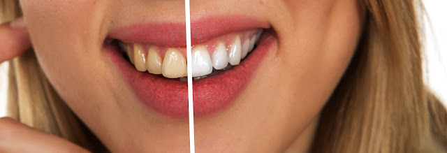 smile makeover of a woman's teeth
