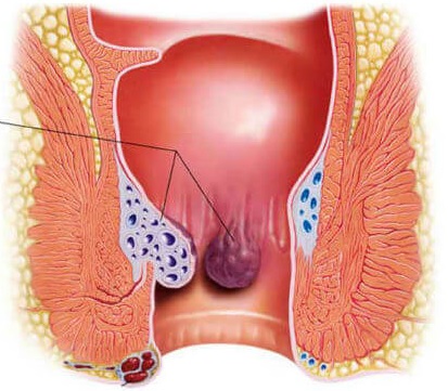 Jual Obat Wasir Ambeien De Nature Di Bengkulu Tengah