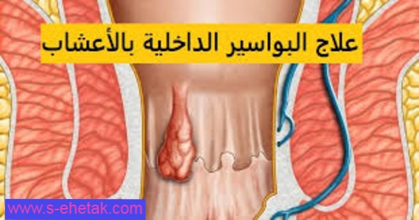 علاج البواسير الداخلية بالاعشاب نهائيا