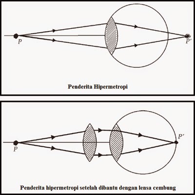 vitamine miopiei progresive hiperopie miopie astigmatism strabism