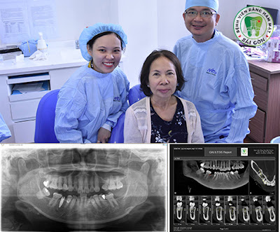 trong-rang-implant-an-toan