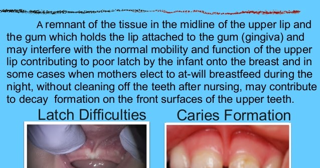 Dentist East Berlin PA What Is A Lip tie tongue-png
