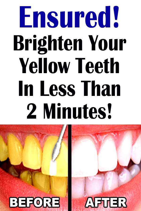 Ensured! Brighten Your Yellow Teeth In Less Than 2 Minutes! Office Health