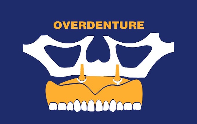 DENTADURA FIXA: Diferença entre Dentadura, Overdenture e Protocolo All on 4 - Dr. Daniel Crivari