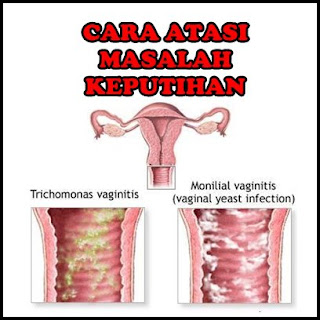 Cara mengatasi keputihan gatal manjur