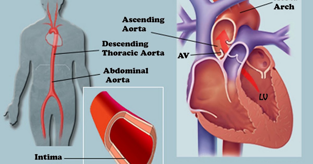 сердце аорта расширена влево. аортальный стеноз рентген. сердце аорта расширена влево. сердце аорта расширена влево. на рентгене расширены границы сердца.