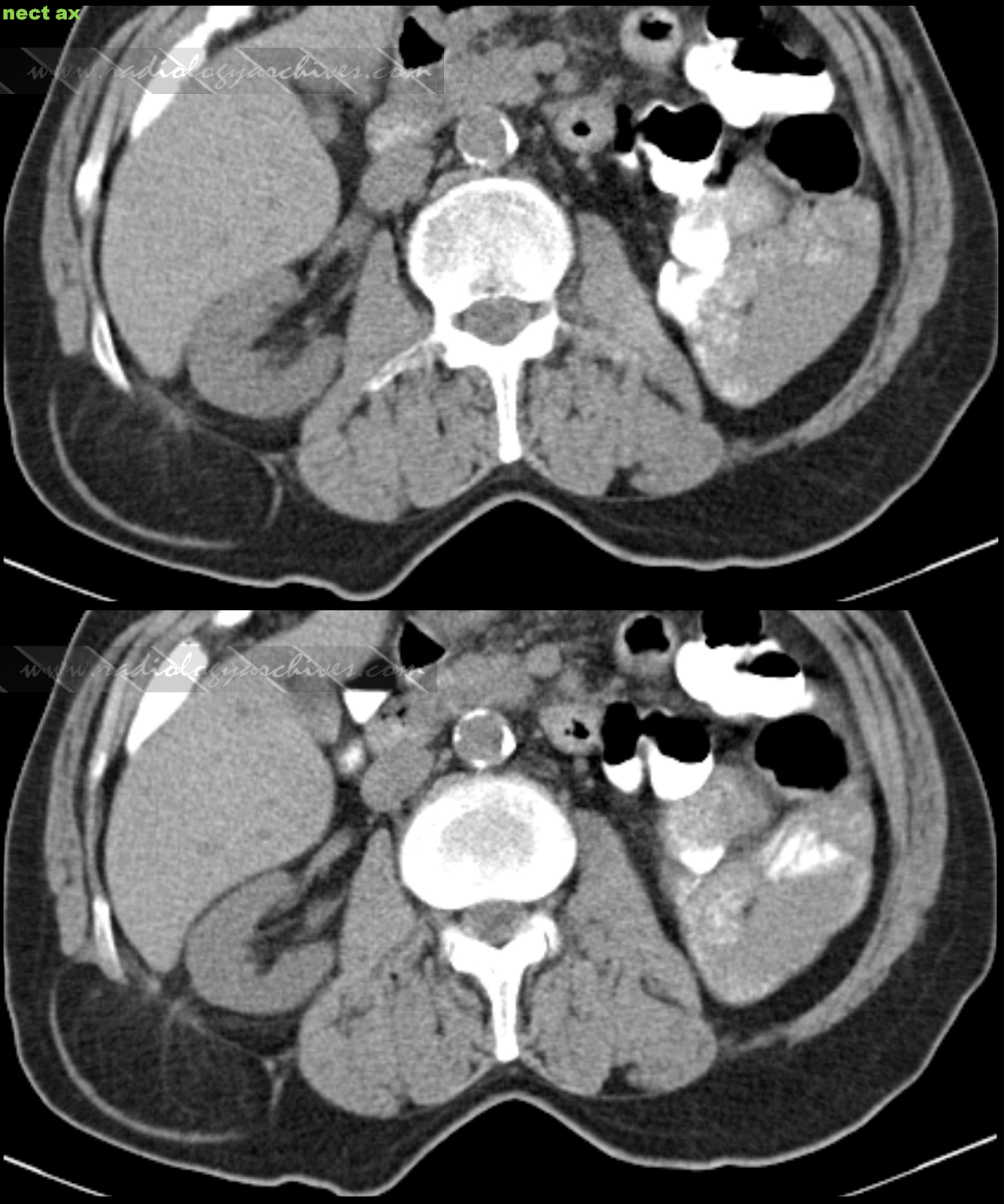 Radiology Archives Οσφυϊκή Κήλη (Οσφυοκήλη Grynfeltt Lesshaft)