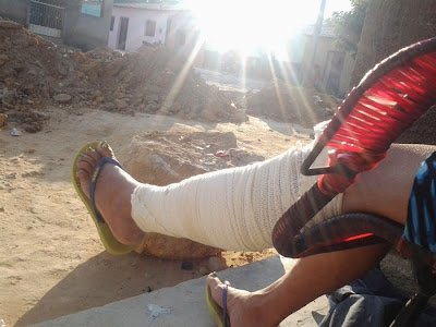Moradora do Distrito do Morais cai em buraco de obra da Prefeitura e sofre lesão na perna