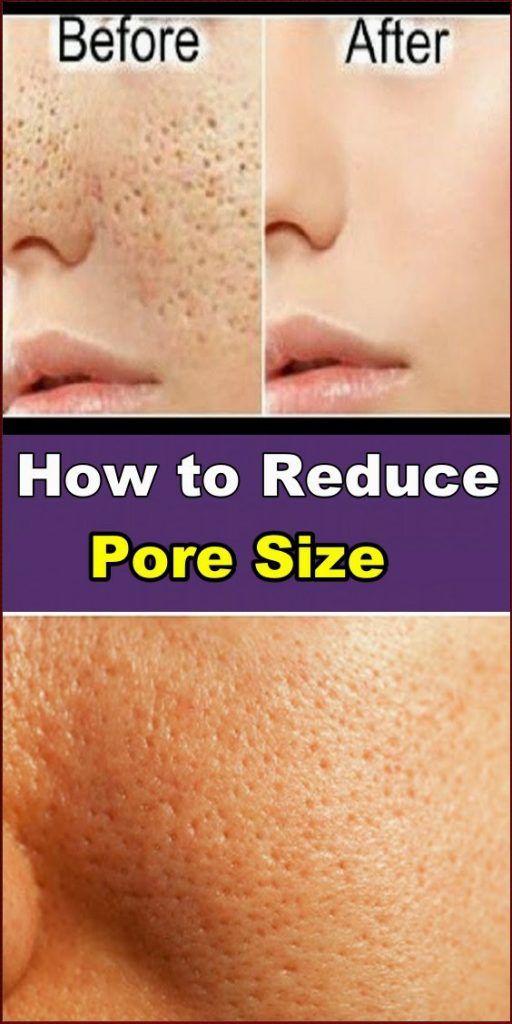 ALL OPEN PORES WILL DISAPPEAR FROM YOUR SKIN FOREVER IN JUST 3 DAYS