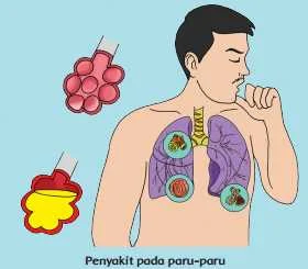 Penyakit pada paru-paru www.simplenews.me