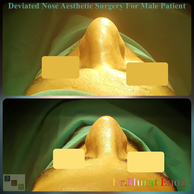 Deviated Nose Aesthetic Surgery, Asymmetric Nose Correction Operation,Rhinoplasty in Men Istanbul,
