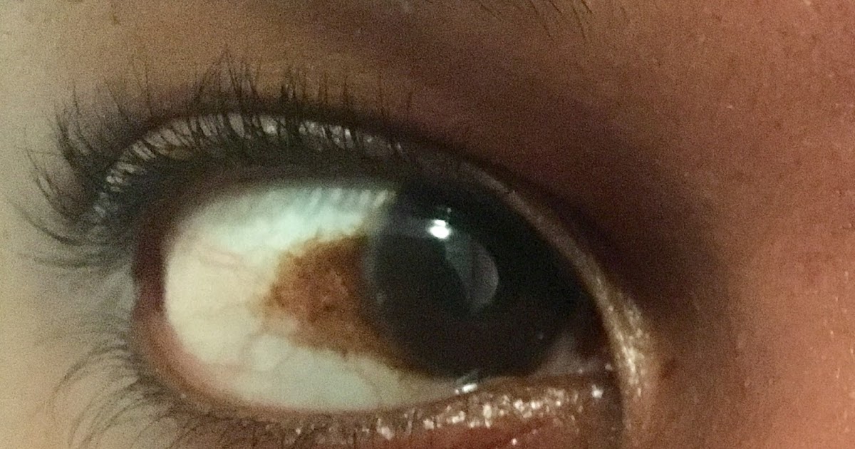 How to get rid of a brown spot / discolouration on the whites of the