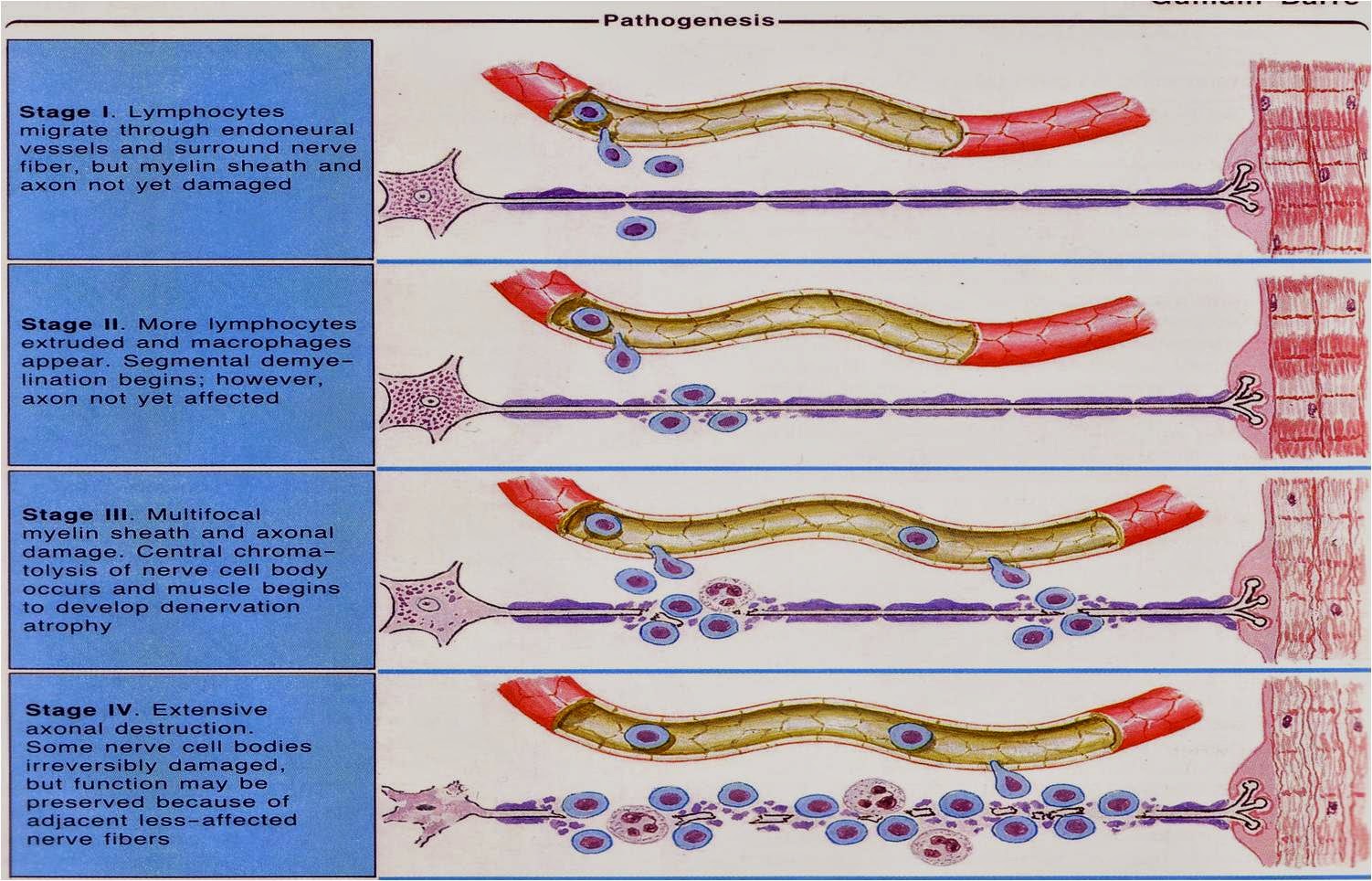 Neuro Habits: Guillain Barre Syndrome (GBS)