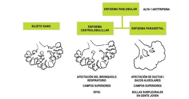Tipos de Enfisema