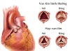 Hẹp van tim: Nguyên nhân, triệu chứng và cách điều trị