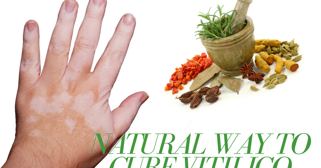 Medical tourism in kerala Vitiligo Ayurveda Treatment in India