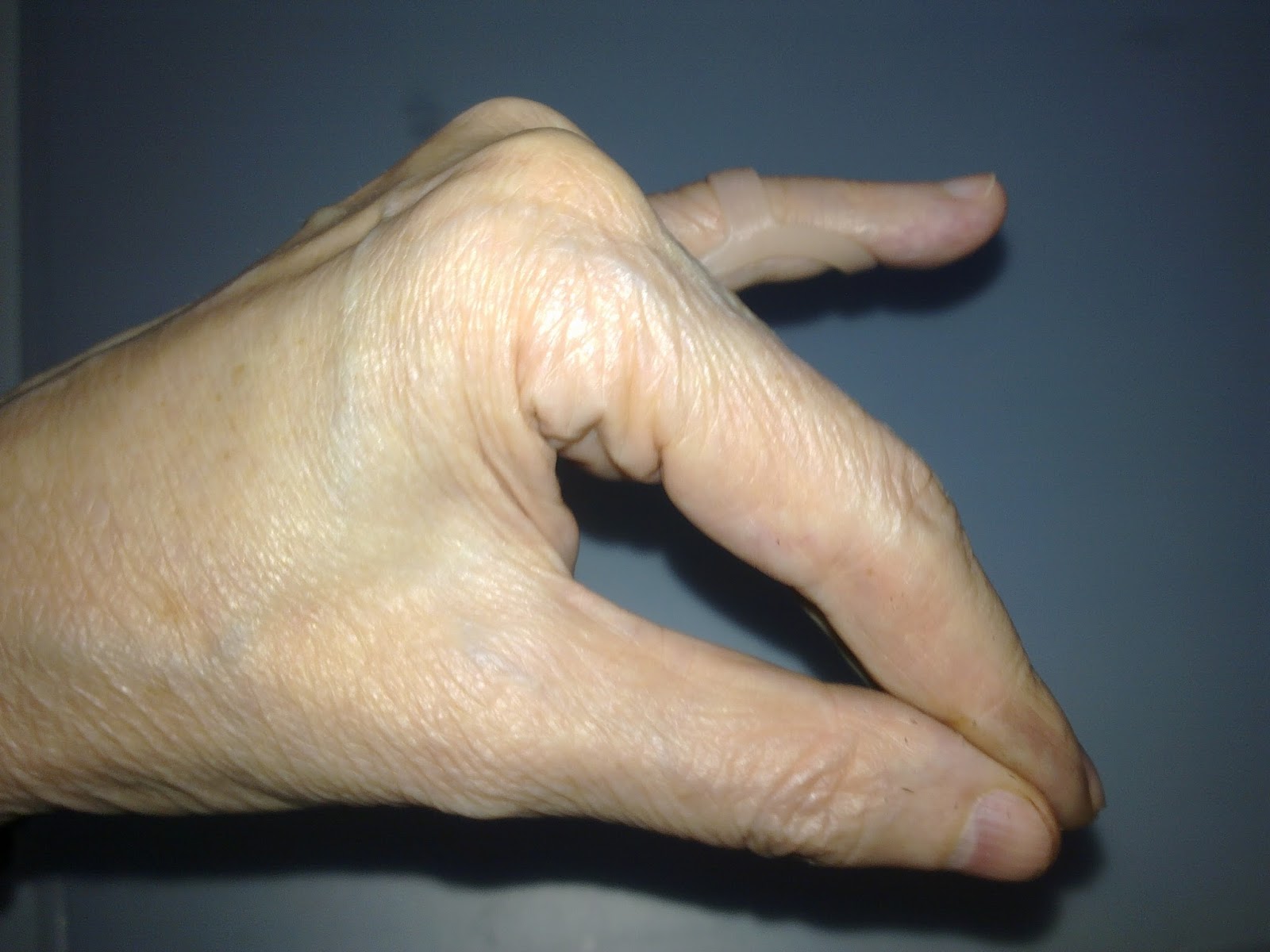 Wrist in plaster cast or finger injury how to remove stiffness or