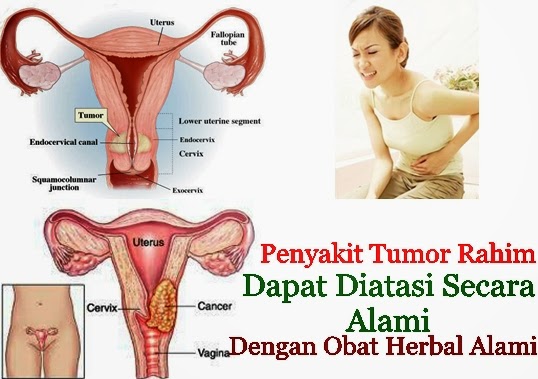 Pengobatan Terbaik Untuk Tumor Rahim