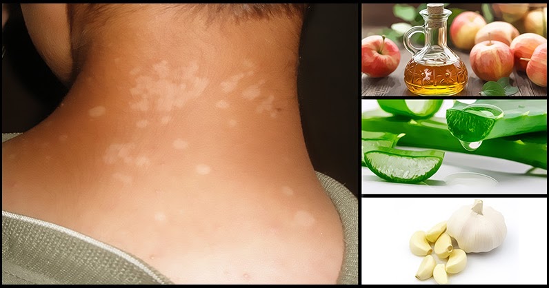 Effective Home Remedies To Treat Tinea Versicolor (An-An) - Dr. Farrah MD