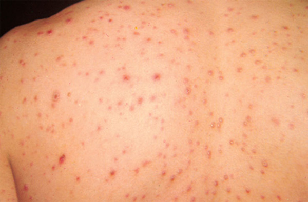 Kasaragod, Health, News, Chickenpox, Health dept warned on chickenpox 