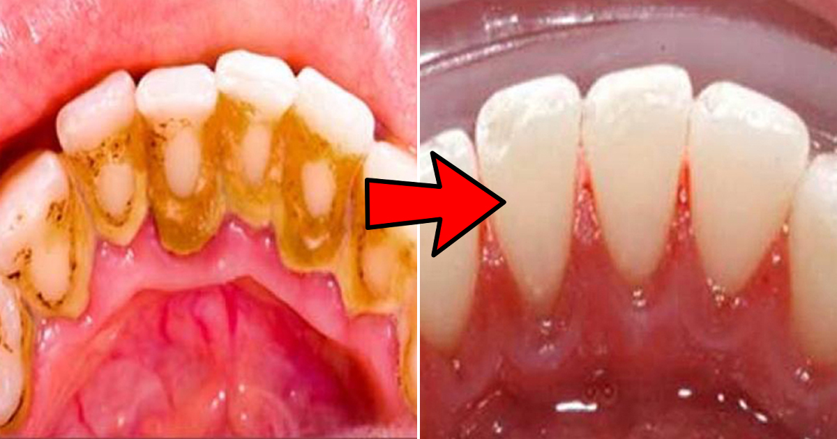 teeth calculus black wiki teeth calculus black wiki