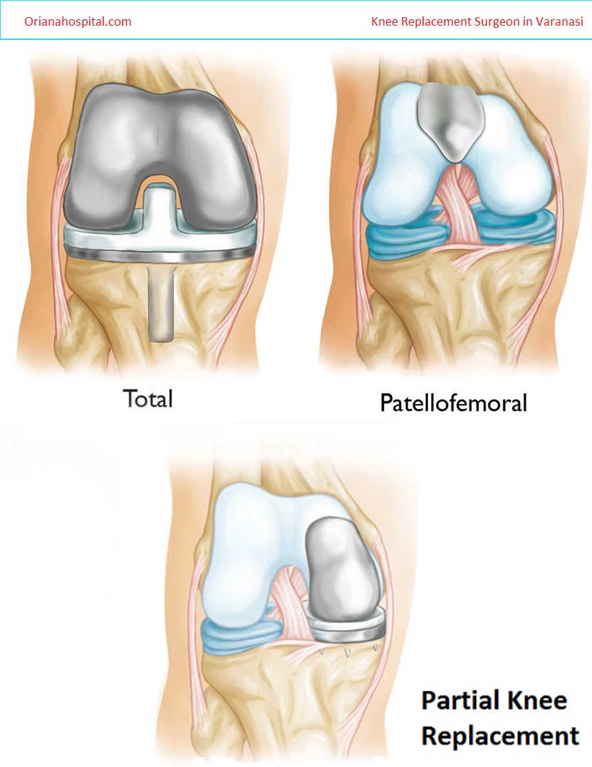 Knee Joint Replacement surgeon in Varanasi india What is involved with